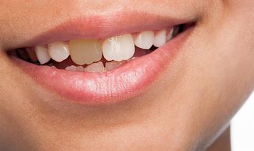 علت و دلایل سیاه شدن دندان‌ ها